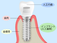 インプラント模式図